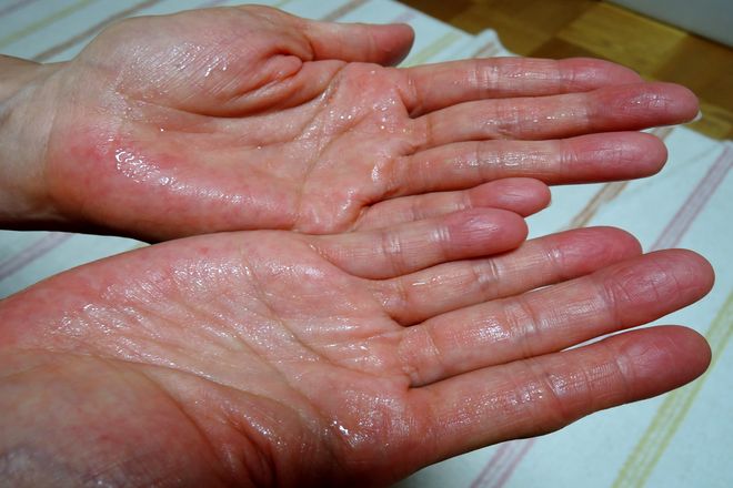 塩化アルミニウム液を手のひら全体に塗ります。