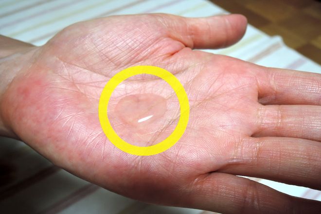 塩化アルミニウム液を手のひらに少量付けます。