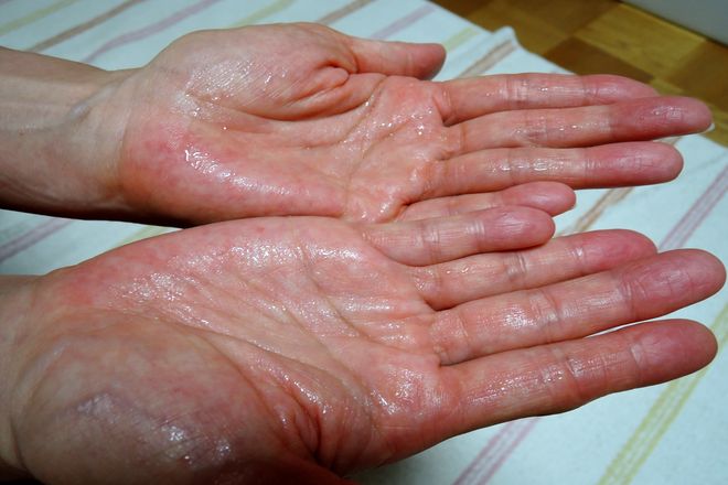手のひらに塩化アルミニウムを二度塗りします。