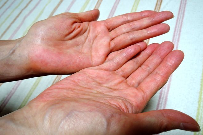 手のひらに塩化アルミニウムを塗って乾かします。